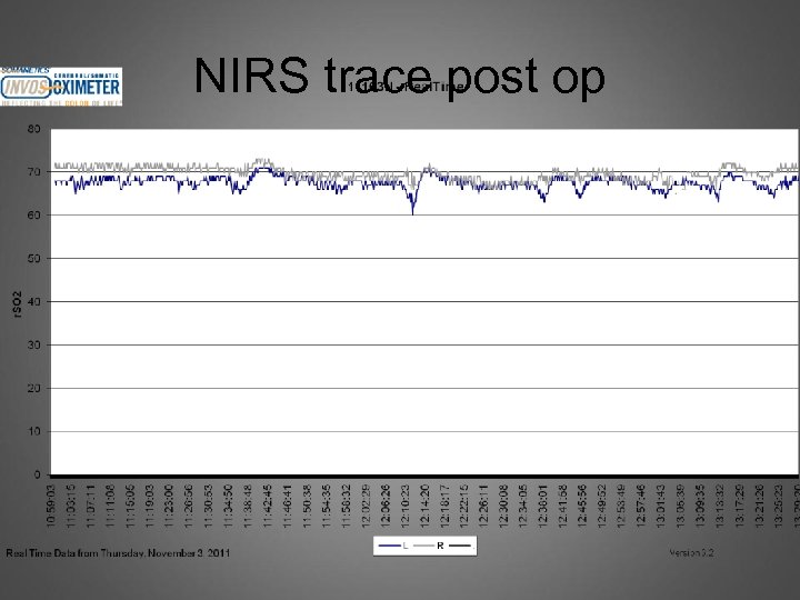 NIRS trace post op 