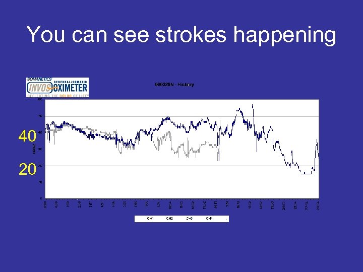 You can see strokes happening 40 20 