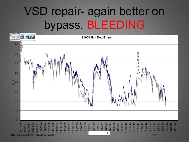 VSD repair- again better on bypass. BLEEDING 
