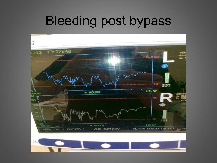 Bleeding post bypass 