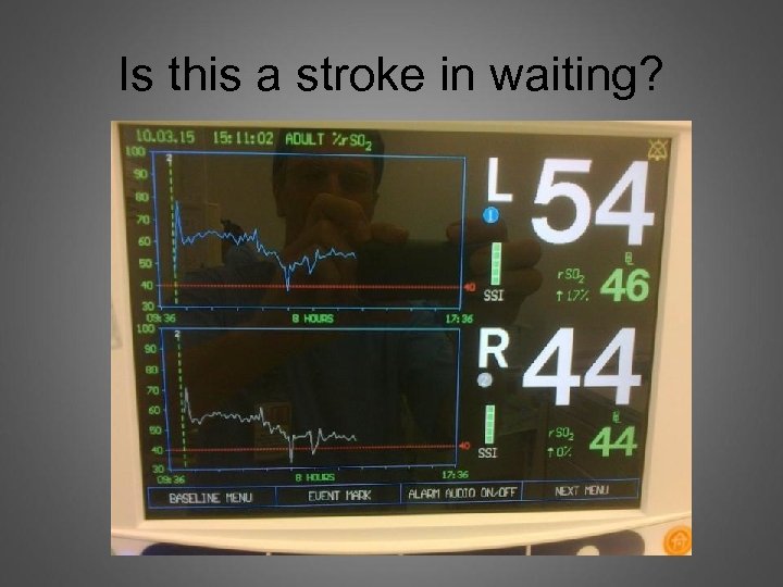 Is this a stroke in waiting? 