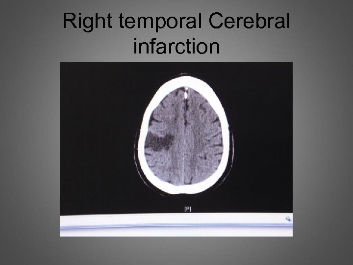 Right temporal Cerebral infarction 