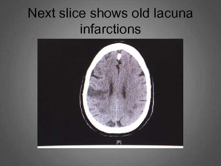 Next slice shows old lacuna infarctions 