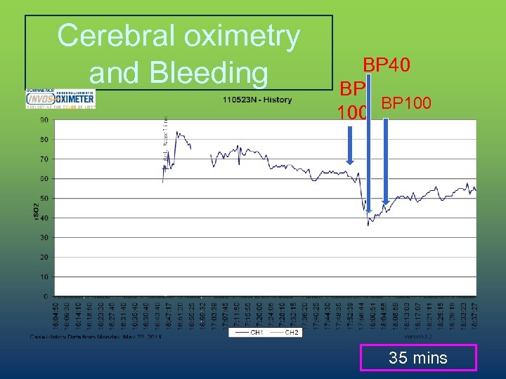 Cerebral oximetry and Bleeding BP 40 BP BP 100 35 mins 