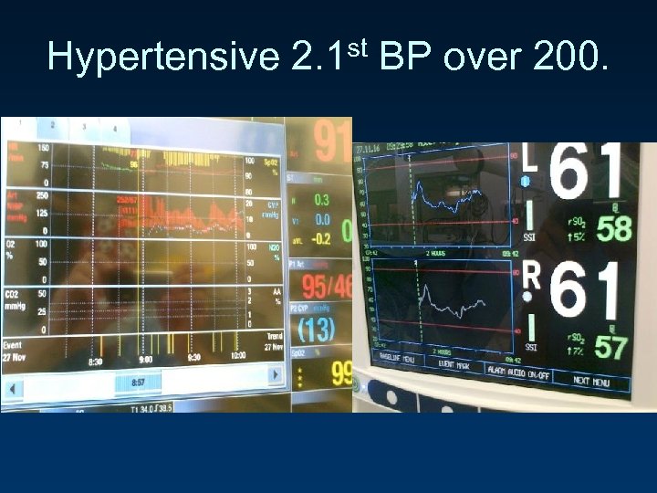 Hypertensive 2. 1 st BP over 200. 