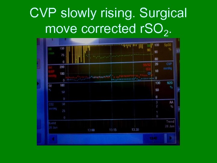 CVP slowly rising. Surgical move corrected r. SO 2. 