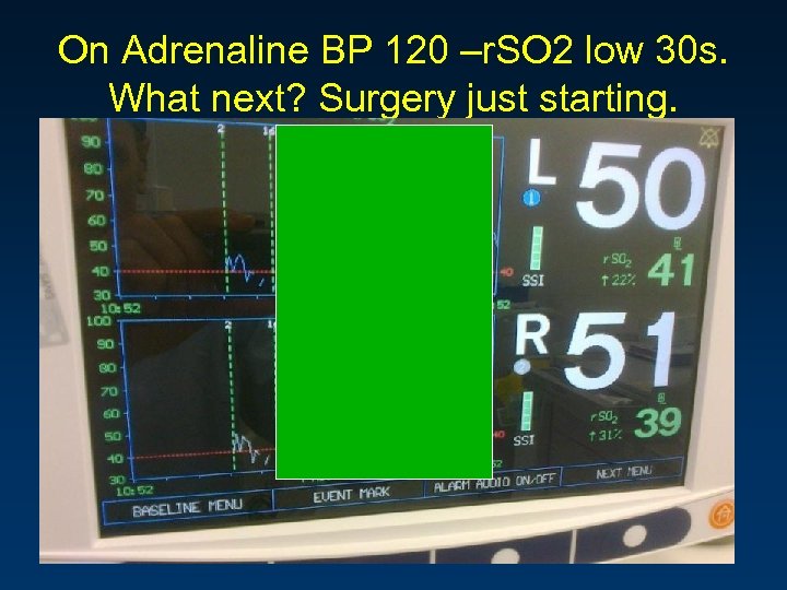 On Adrenaline BP 120 –r. SO 2 low 30 s. What next? Surgery just
