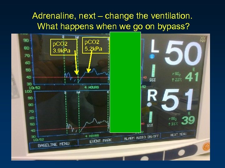 Adrenaline, next – change the ventilation. What happens when we go on bypass? p.