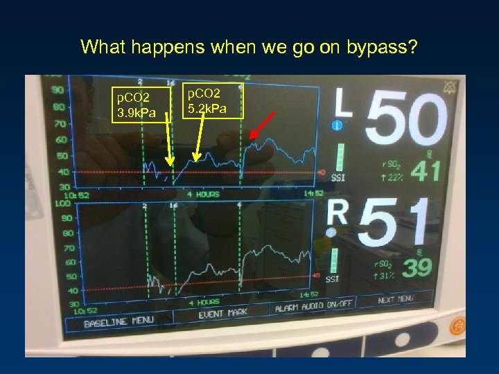 What happens when we go on bypass? p. CO 2 3. 9 k. Pa
