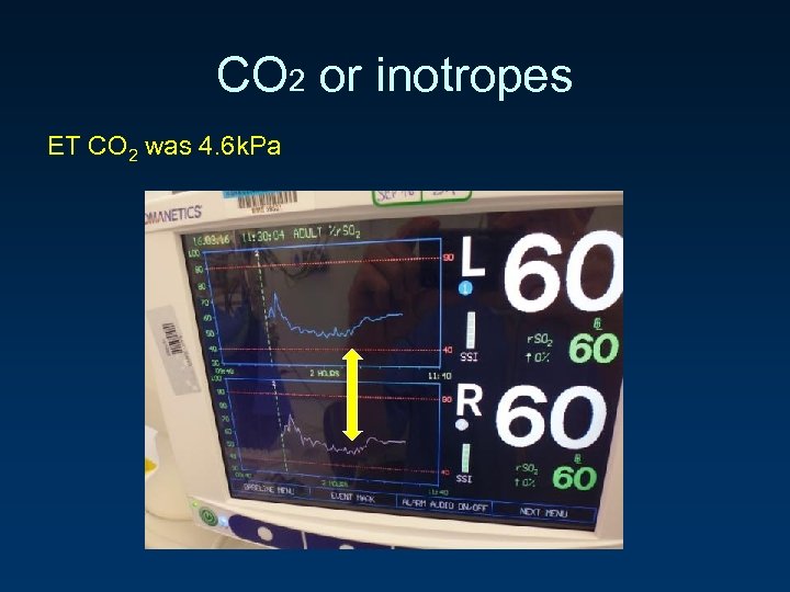 CO 2 or inotropes ET CO 2 was 4. 6 k. Pa 