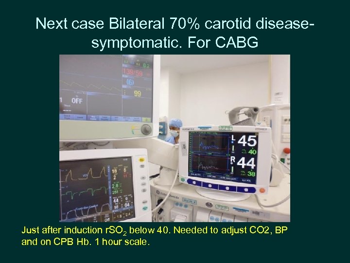 Next case Bilateral 70% carotid diseasesymptomatic. For CABG Just after induction r. SO 2