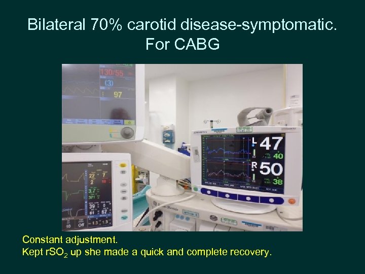 Bilateral 70% carotid disease-symptomatic. For CABG Constant adjustment. Kept r. SO 2 up she