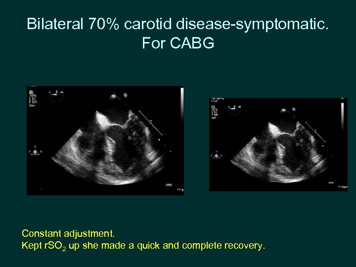 Bilateral 70% carotid disease-symptomatic. For CABG Constant adjustment. Kept r. SO 2 up she