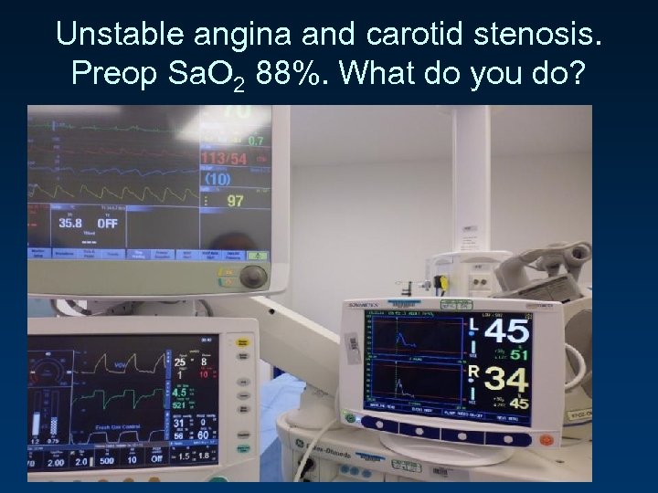Unstable angina and carotid stenosis. Preop Sa. O 2 88%. What do you do?