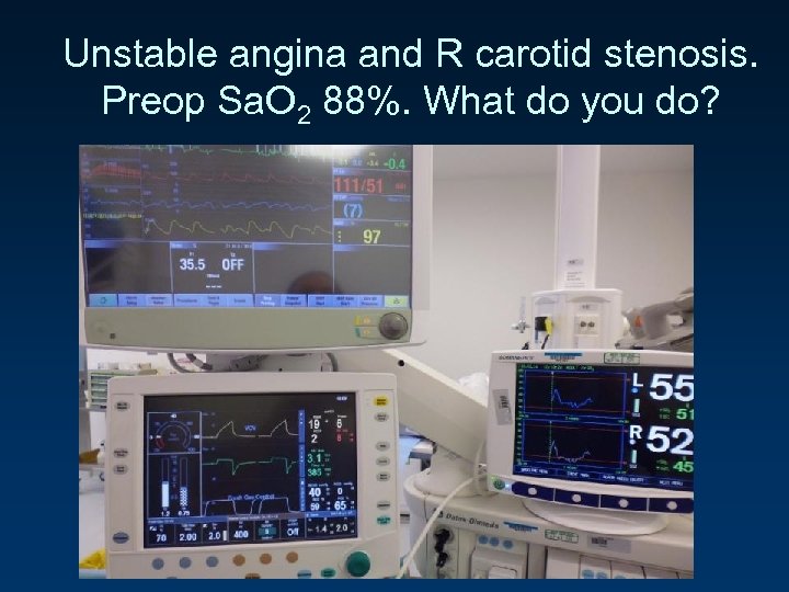 Unstable angina and R carotid stenosis. Preop Sa. O 2 88%. What do you