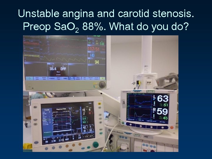 Unstable angina and carotid stenosis. Preop Sa. O 2 88%. What do you do?