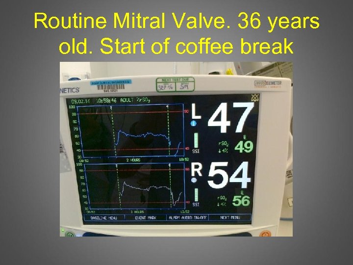 Routine Mitral Valve. 36 years old. Start of coffee break 