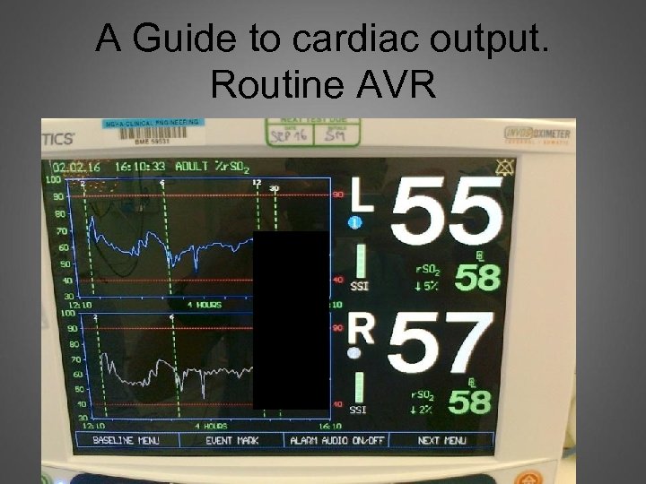 A Guide to cardiac output. Routine AVR 