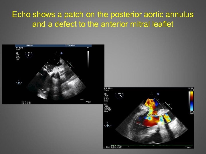 Echo shows a patch on the posterior aortic annulus and a defect to the