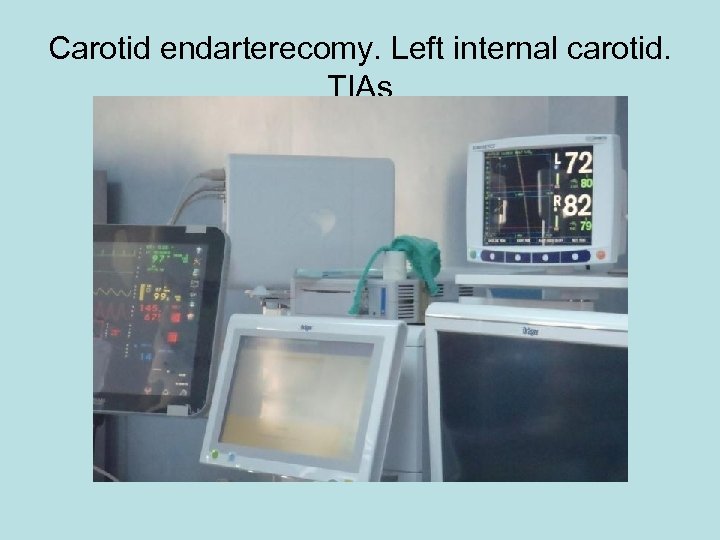 Carotid endarterecomy. Left internal carotid. TIAs 