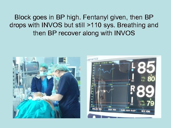 Block goes in BP high. Fentanyl given, then BP drops with INVOS but still