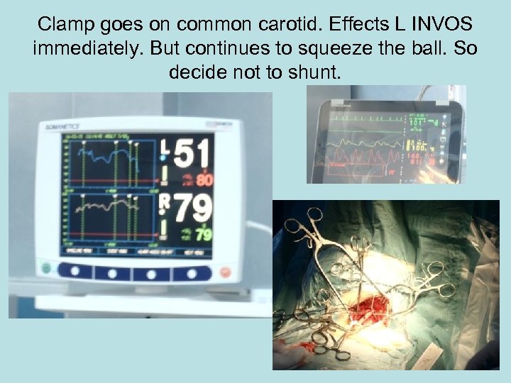 Clamp goes on common carotid. Effects L INVOS immediately. But continues to squeeze the