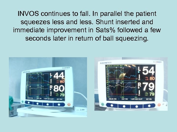 INVOS continues to fall. In parallel the patient squeezes less and less. Shunt inserted