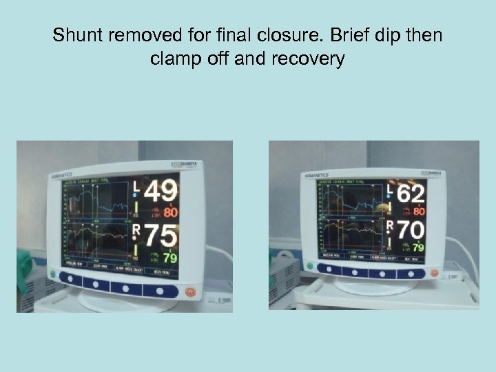 Shunt removed for final closure. Brief dip then clamp off and recovery 