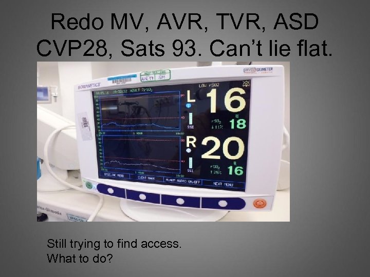Redo MV, AVR, TVR, ASD CVP 28, Sats 93. Can’t lie flat. Still trying