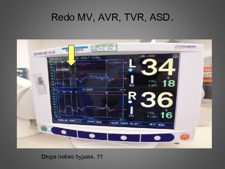Redo MV, AVR, TVR, ASD. Drops before bypass. ? ? 