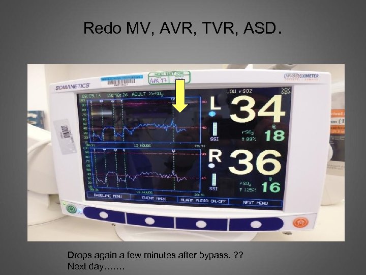 Redo MV, AVR, TVR, ASD. Drops again a few minutes after bypass. ? ?