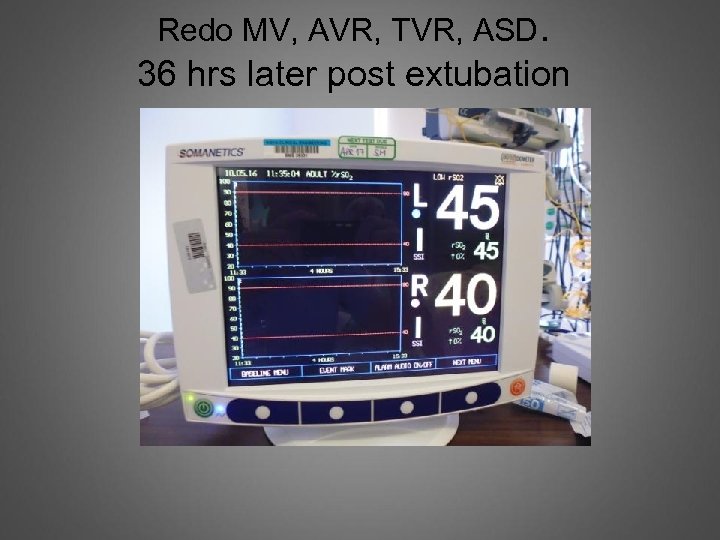 Redo MV, AVR, TVR, ASD. 36 hrs later post extubation 