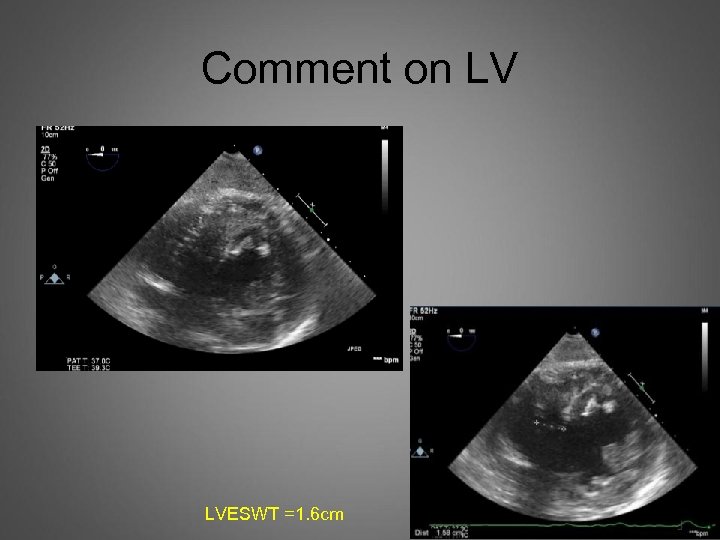 Comment on LV LVESWT =1. 6 cm 