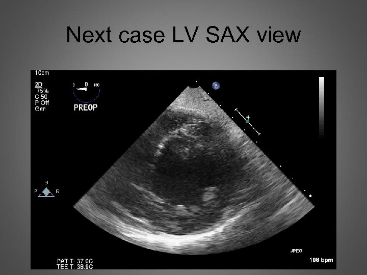 Next case LV SAX view 