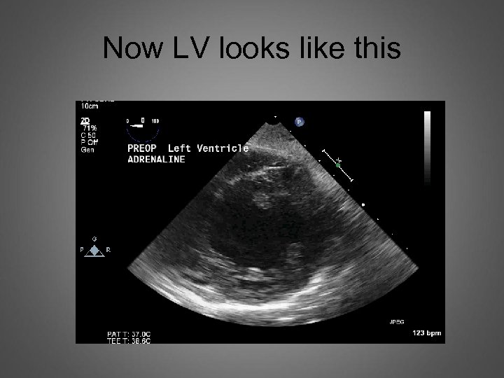 Now LV looks like this 