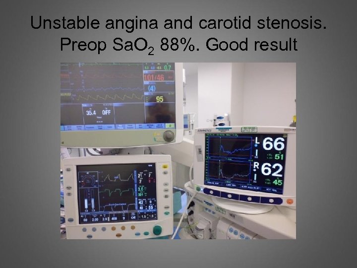 Unstable angina and carotid stenosis. Preop Sa. O 2 88%. Good result 