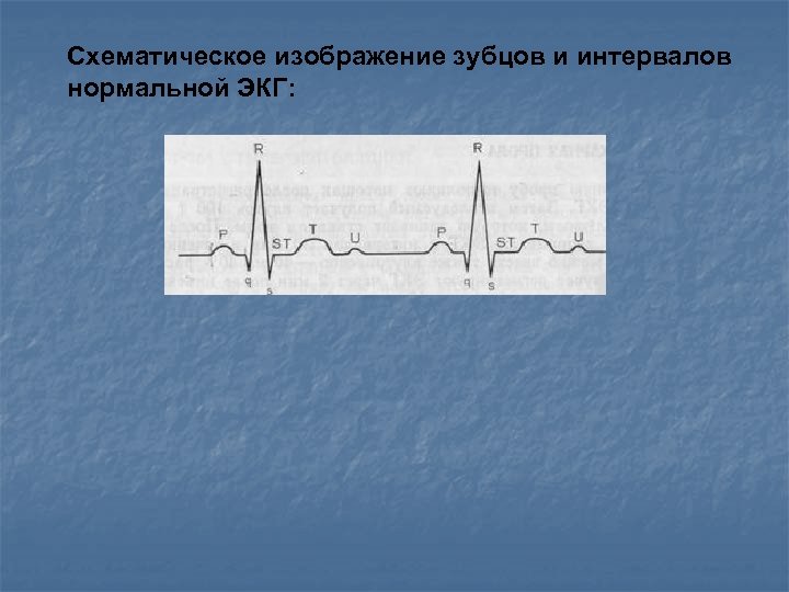 Схематическое изображение зубцов и интервалов нормальной ЭКГ: 