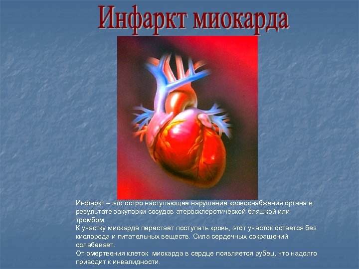 Инфаркт – это остро наступающее нарушение кровоснабжения органа в результате закупорки сосудов атеросклеротической бляшкой