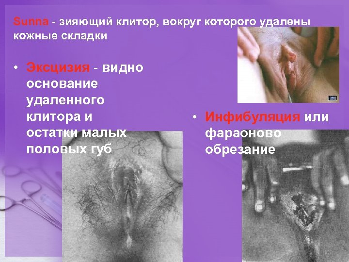 Sunna - зияющий клитор, вокруг которого удалены кожные складки • Эксцизия - видно основание