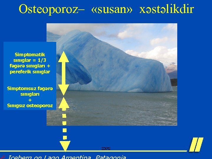 Osteoporoz– «susan» xəstəlikdir Simptomatik sınıglar = 1/3 fəgərə sınıgları + pereferik sınıglar Simptomsuz fəgərə