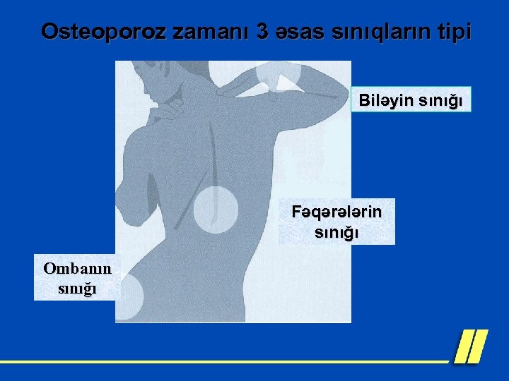 Osteoporoz zamanı 3 əsas sınıqların tipi Biləyin sınığı Fəqərələrin sınığı Ombanın sınığı 