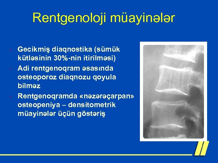 Rentgenoloji müayinələr - Gecikmiş diaqnostika (sümük kütləsinin 30%-nin itirilməsi) - Adi rentgenoqram əsasında osteoporoz