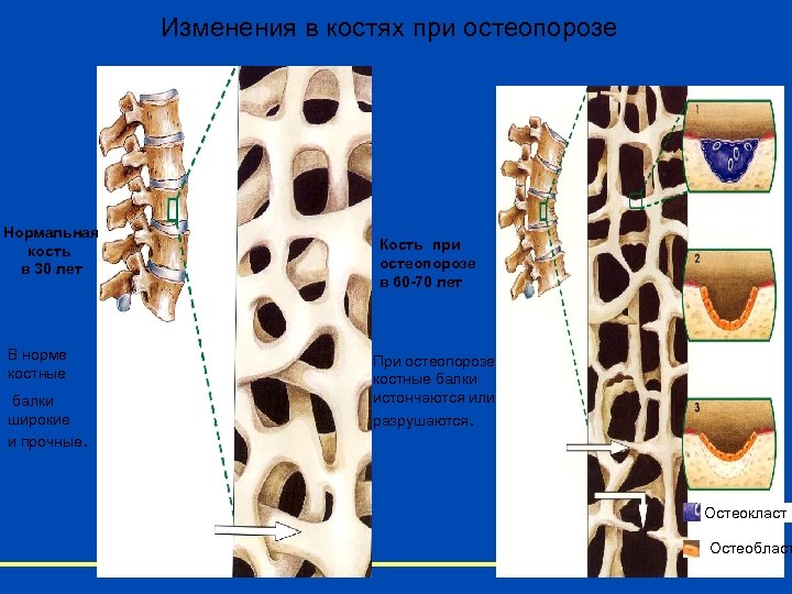 Кости при остеопорозе фото