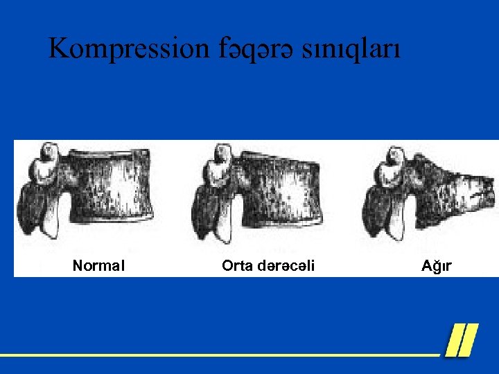 Kompression fəqərə sınıqları Normal Orta dərəcəli Ağır 