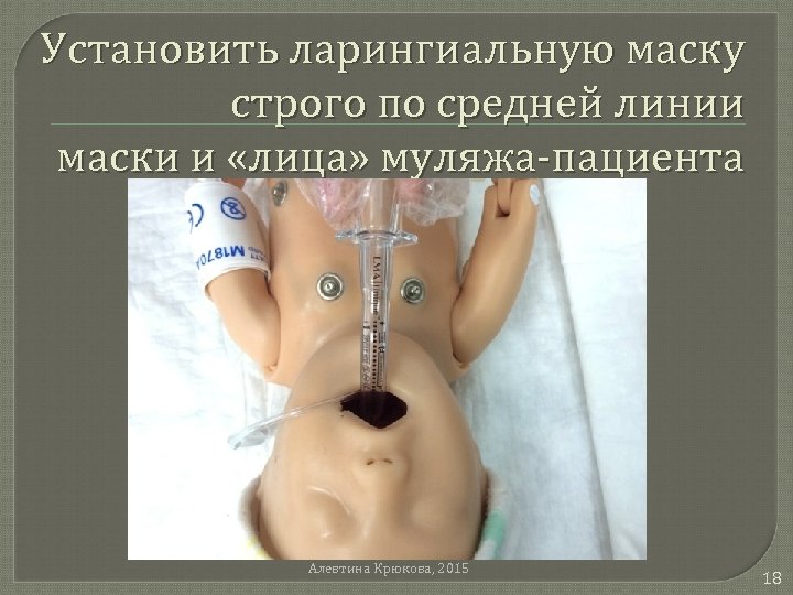 Установить ларингиальную маску строго по средней линии маски и «лица» муляжа-пациента Алевтина Крюкова, 2015