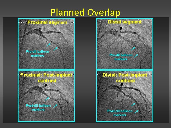 Planned Overlap Proximal segment Pre-dil balloon markers Proximal: Post-implant contrast Post-dil balloon markers Distal