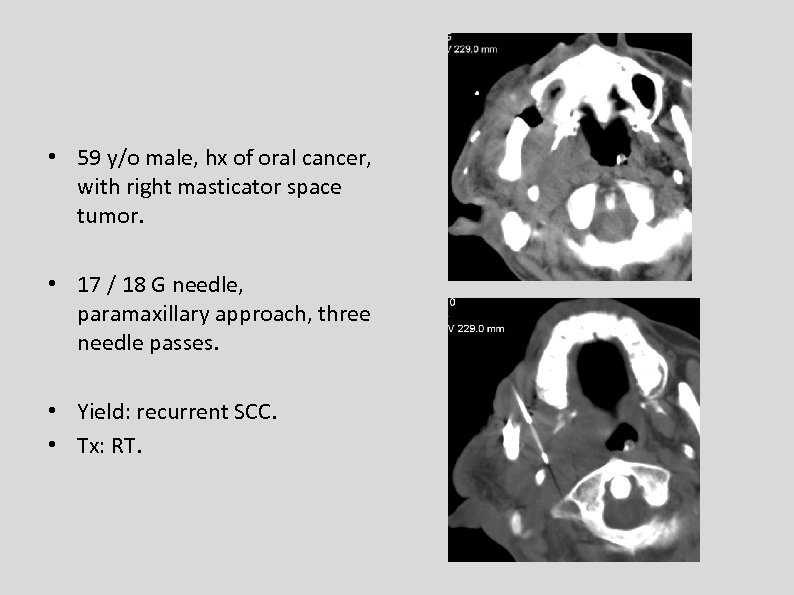  • 59 y/o male, hx of oral cancer, with right masticator space tumor.