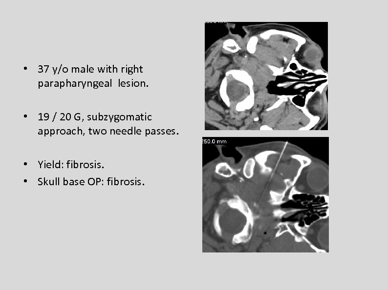  • 37 y/o male with right parapharyngeal lesion. • 19 / 20 G,