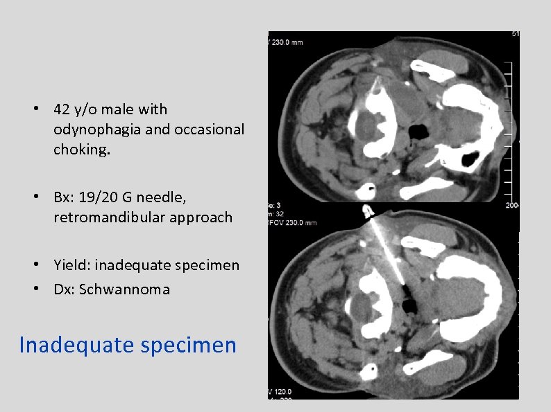  • 42 y/o male with odynophagia and occasional choking. • Bx: 19/20 G