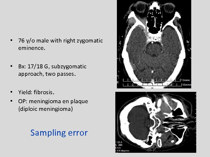  • 76 y/o male with right zygomatic eminence. • Bx: 17/18 G, subzygomatic